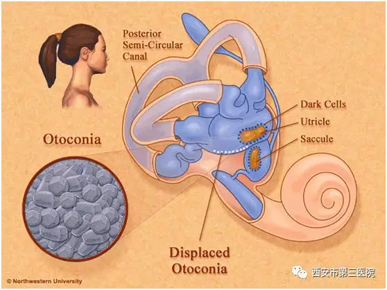 和大家一起聊聊耳石症的哪些事