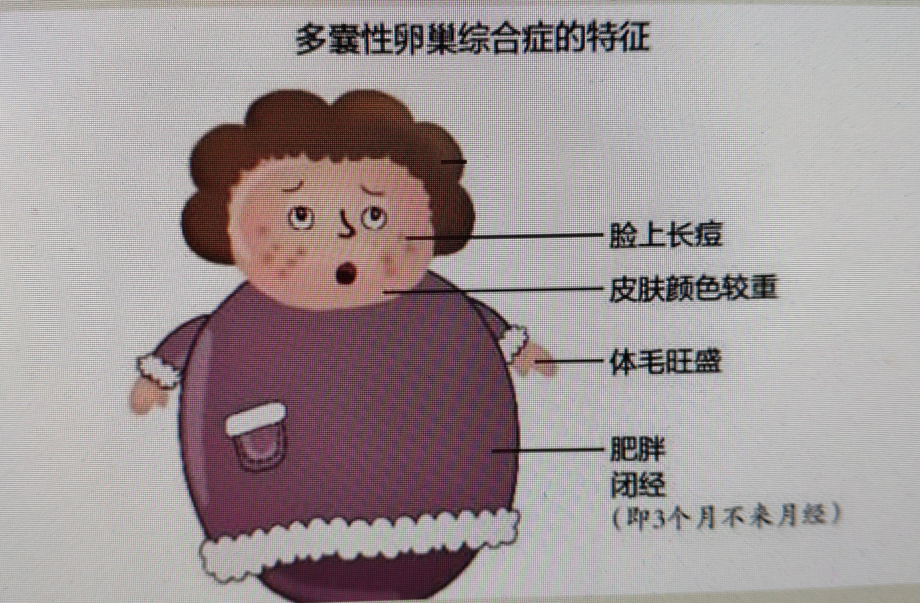 爱助孕!为什么会患多囊卵巢综合症"福星高照"-第2张图片-康夫博客