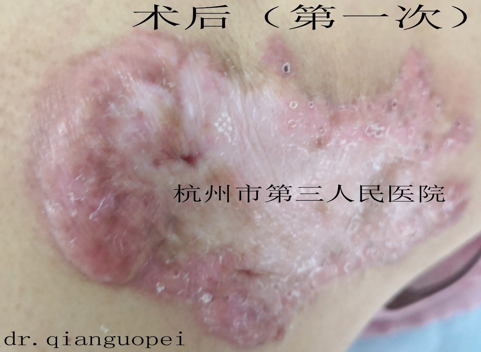 脚底黑痣癌变_黑痣会癌变吗_黑痣癌变图片