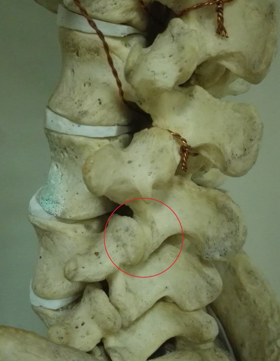 上圖中黃醫生畫圈的部位就是典型的腰椎關節突關節(俗稱腰椎小關節)