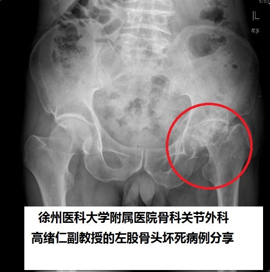 發育性髖關節發育不良半脫位,髖關節骨性關節炎,類風溼性關節炎等終末