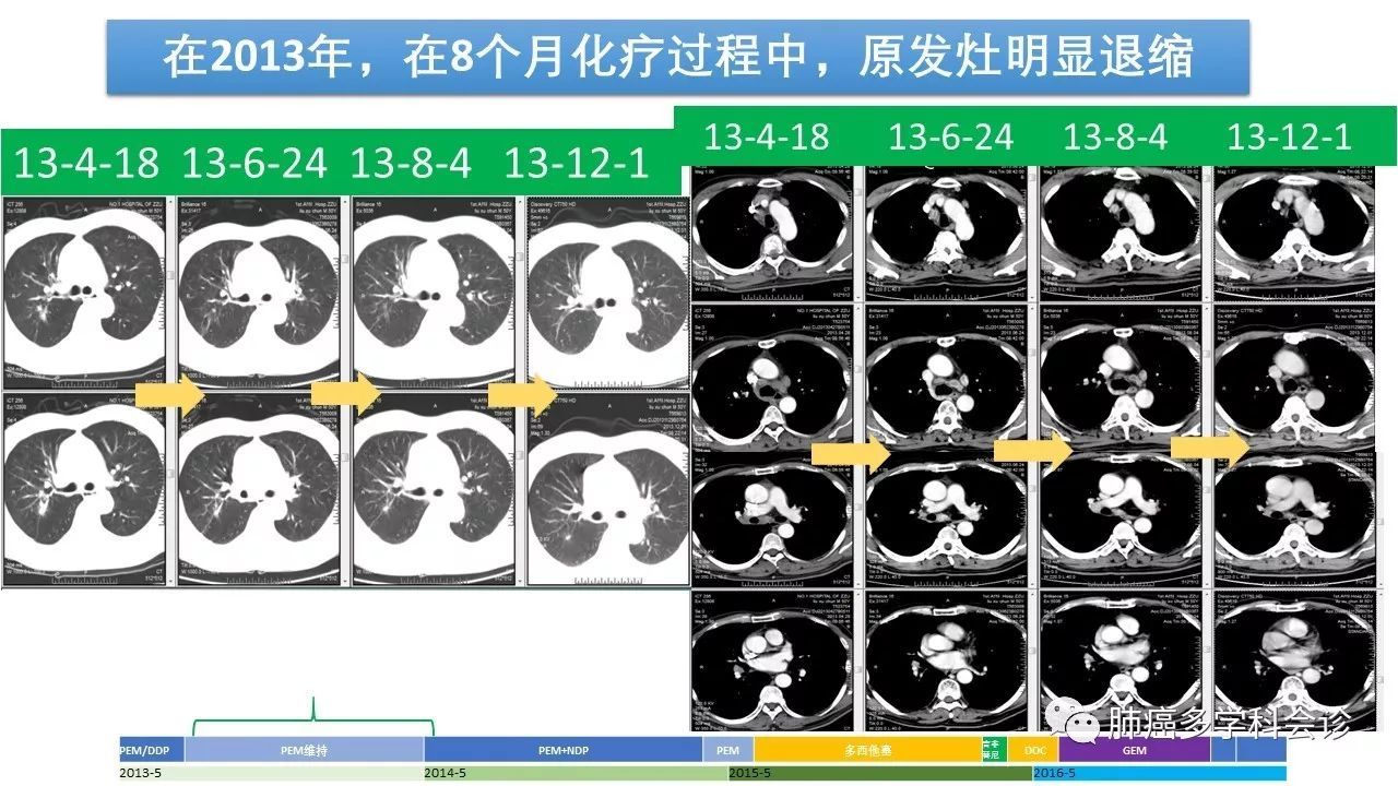 例2小結關於基因檢測2013-4確診為肺腺癌腦轉移骨轉移,反覆化療至2017