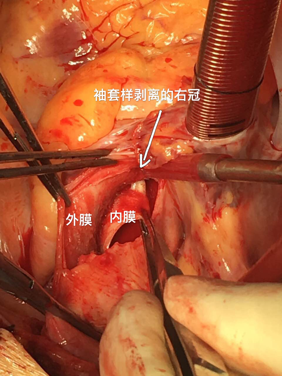 外組進行手術,打開縱膈後,李院長與邵峻主任發現右冠狀動脈袖套樣剝離