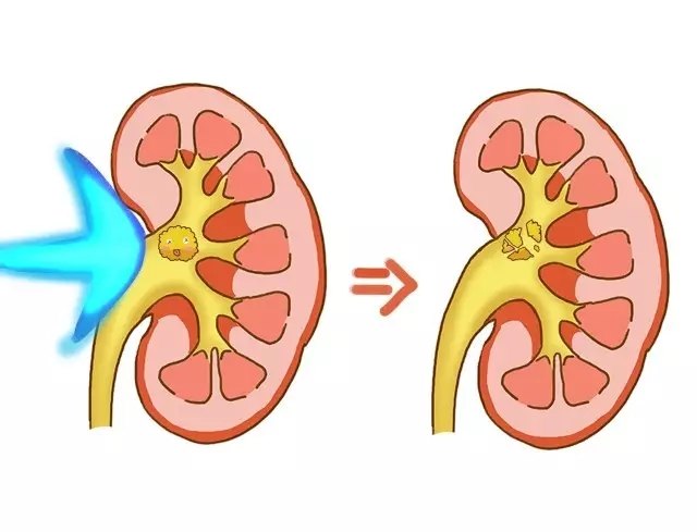 超萌漫畫告訴你腎結石的形成及如何預防