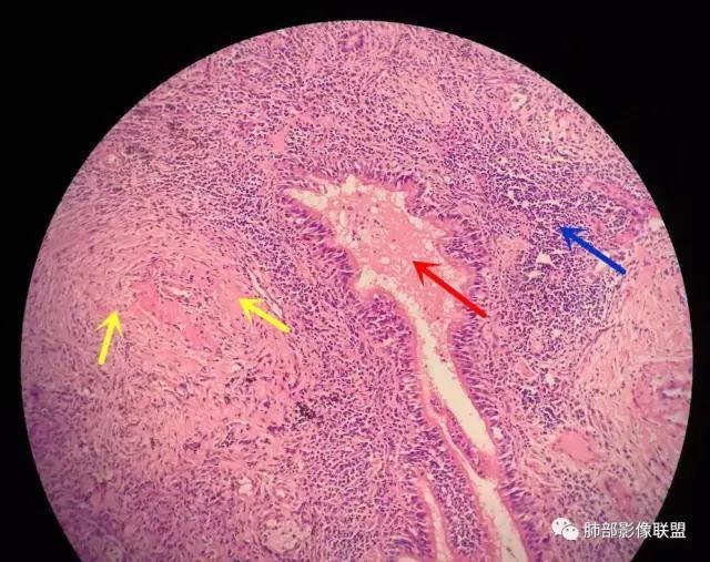 病理3期第7講肺部肉芽腫性炎普通慢性炎膿腫病理