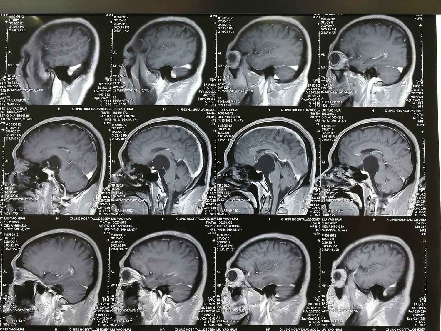 贺晓生教授神经外科手术谈—"鞍上囊肿手术123" - 好大夫在线
