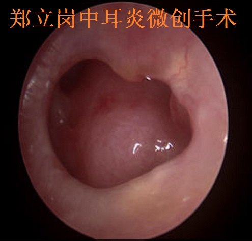 前言:中耳炎微創手術是目前治療慢性化膿性中耳炎及膽脂瘤型中耳炎最