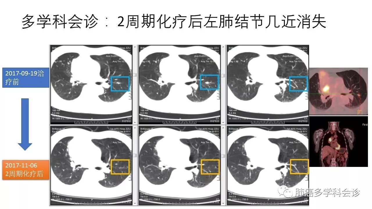 遠端阻塞性肺炎;縱隔及雙肺門淋巴結代謝活躍,雙肺多發軟組織及高密度