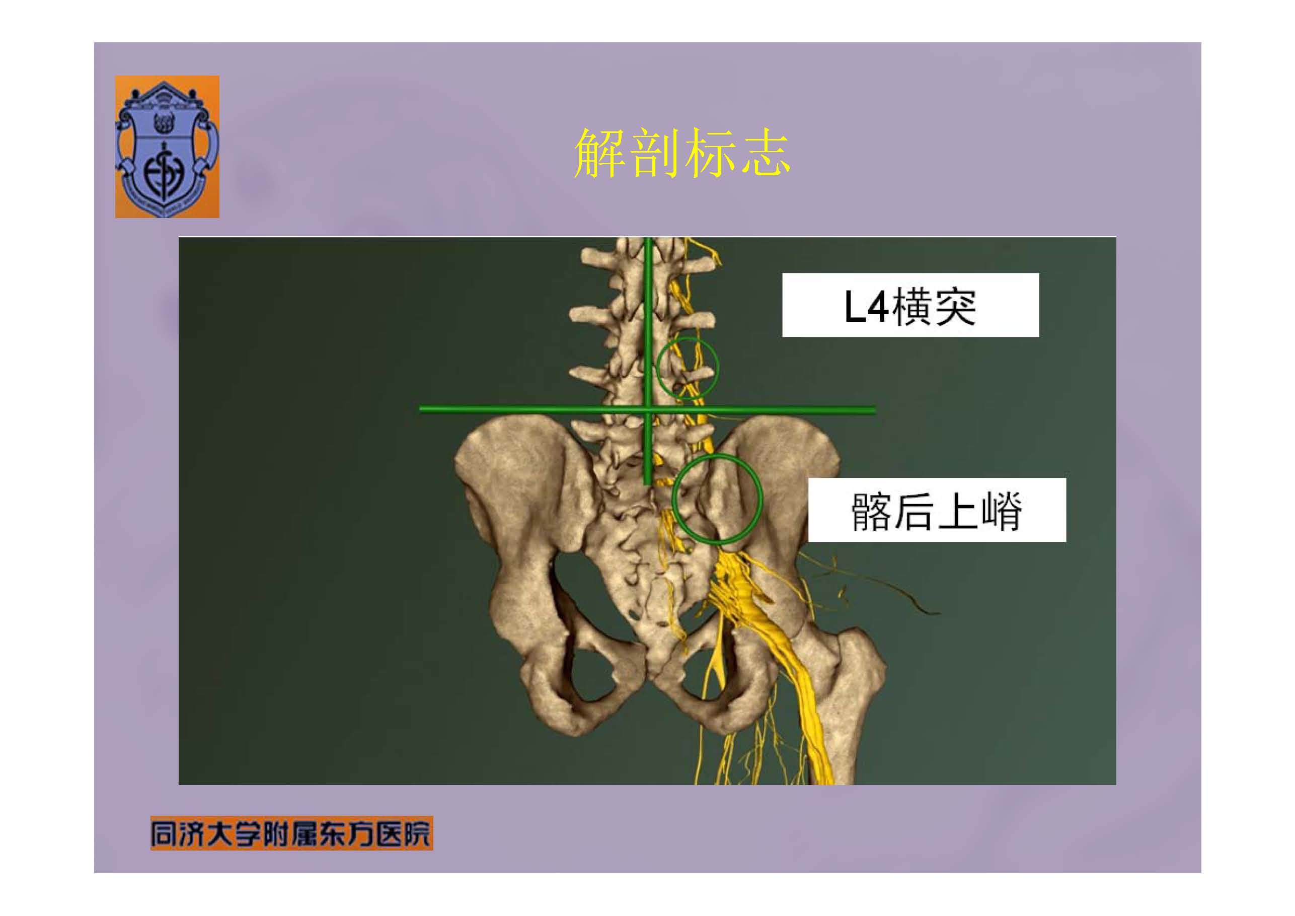 实用腰丛神经阻滞