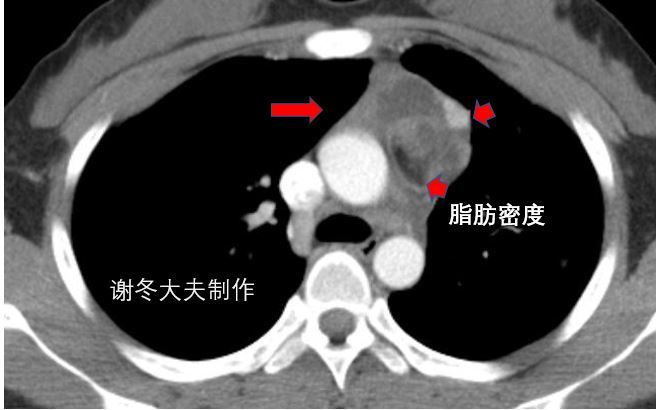 胸腺瘤前縱隔腫塊前縱隔結節前縱隔佔位伴有肌無力是癌症嗎