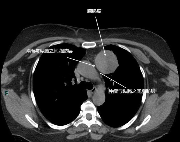 哪些胸腺瘤不能手術?4.其他檢查包括:肺功能,心電圖,動脈血氣