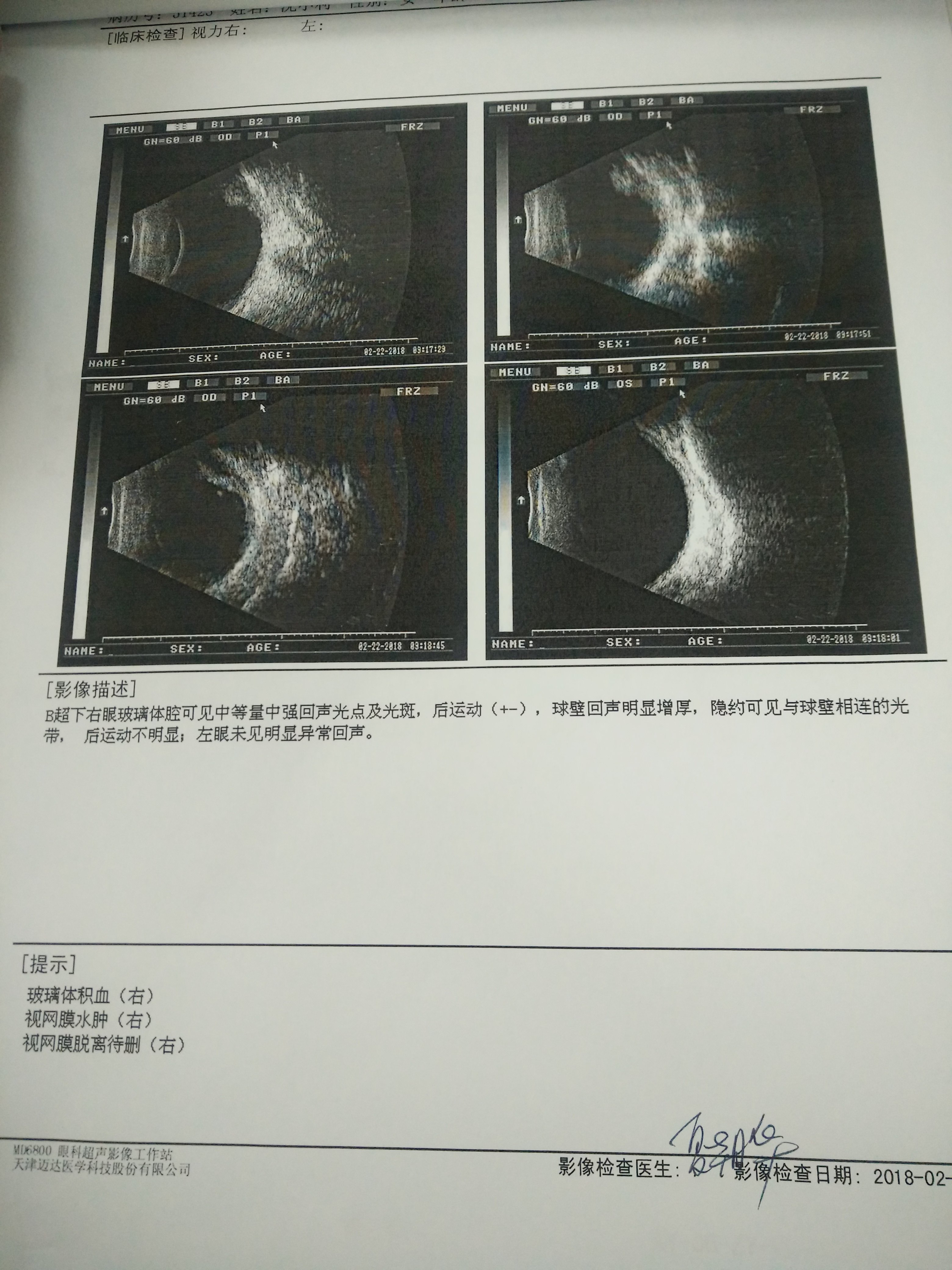 前房积血 m.haodf.com