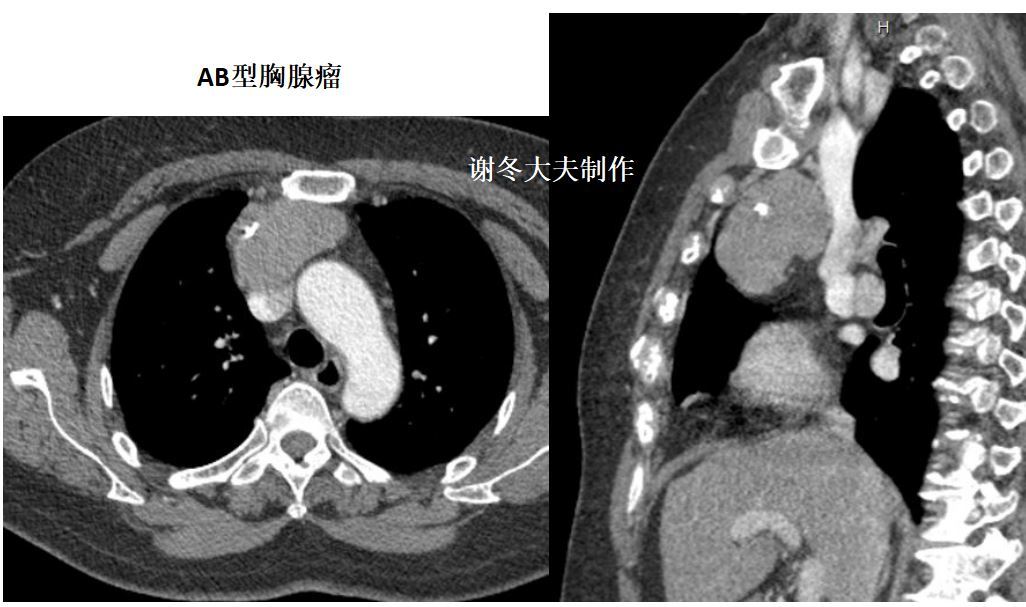 胸腺瘤前縱隔腫塊前縱隔結節前縱隔佔位伴有肌無力是癌症嗎