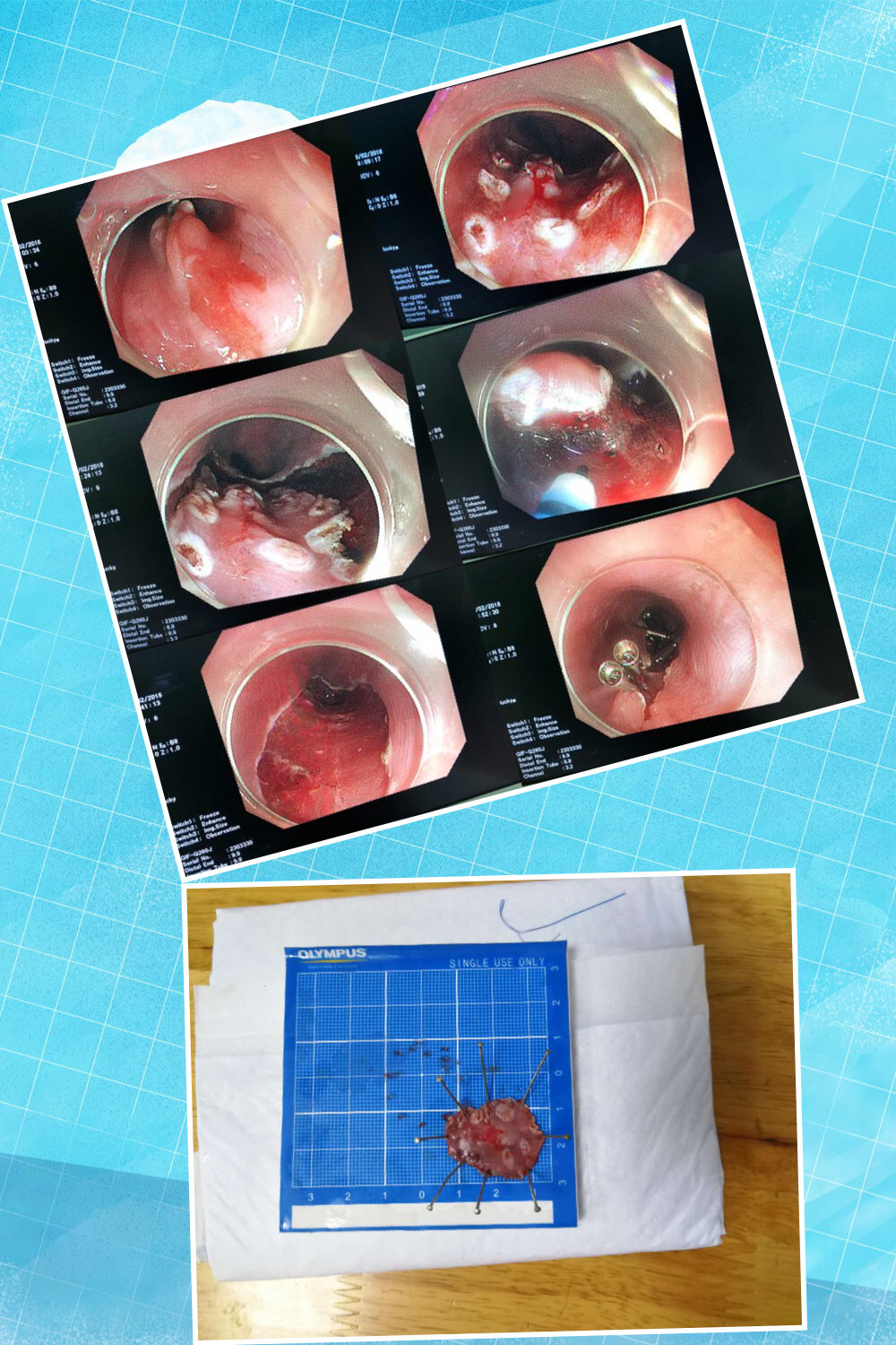 早期食管癌esd(內鏡下黏膜剝離術)術後及預防_食道癌_疾病介紹_預防