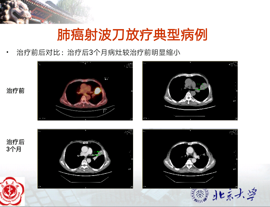 射波刀放疗治疗肺癌临床疗效分享