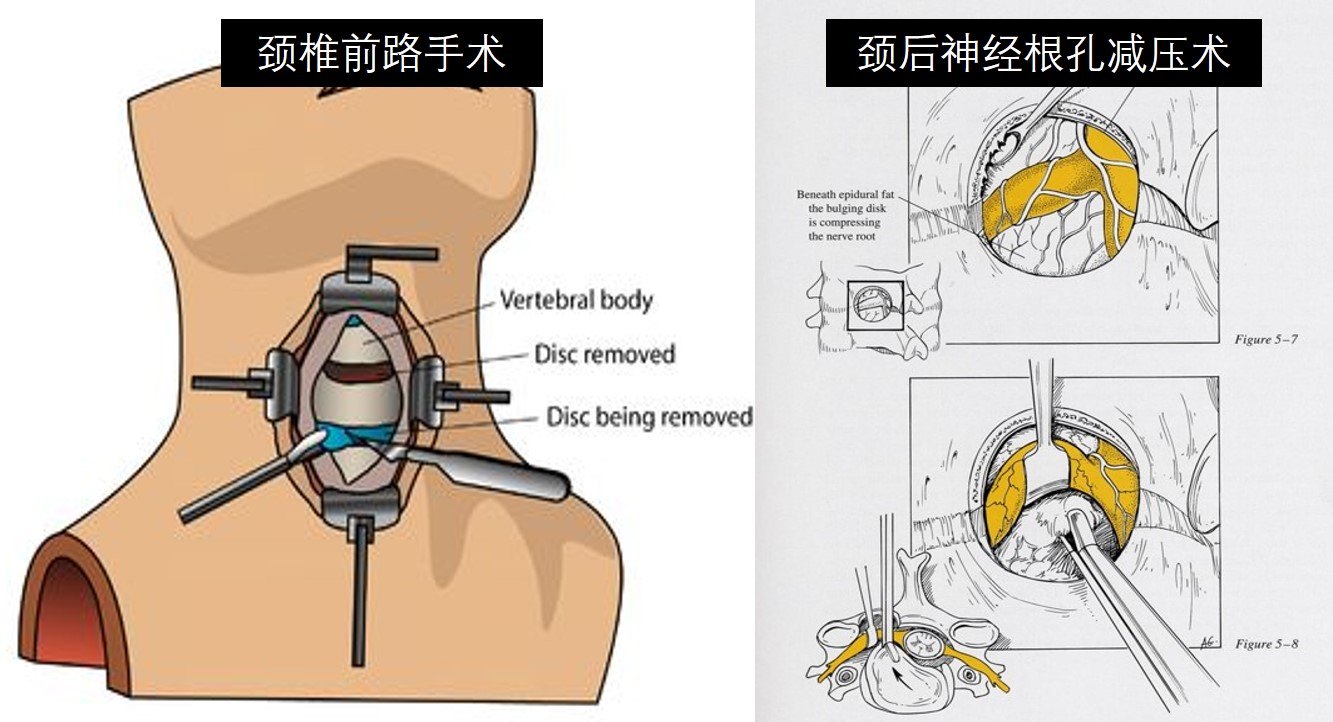 神經根型頸椎病最常見手術效果最好的頸椎病