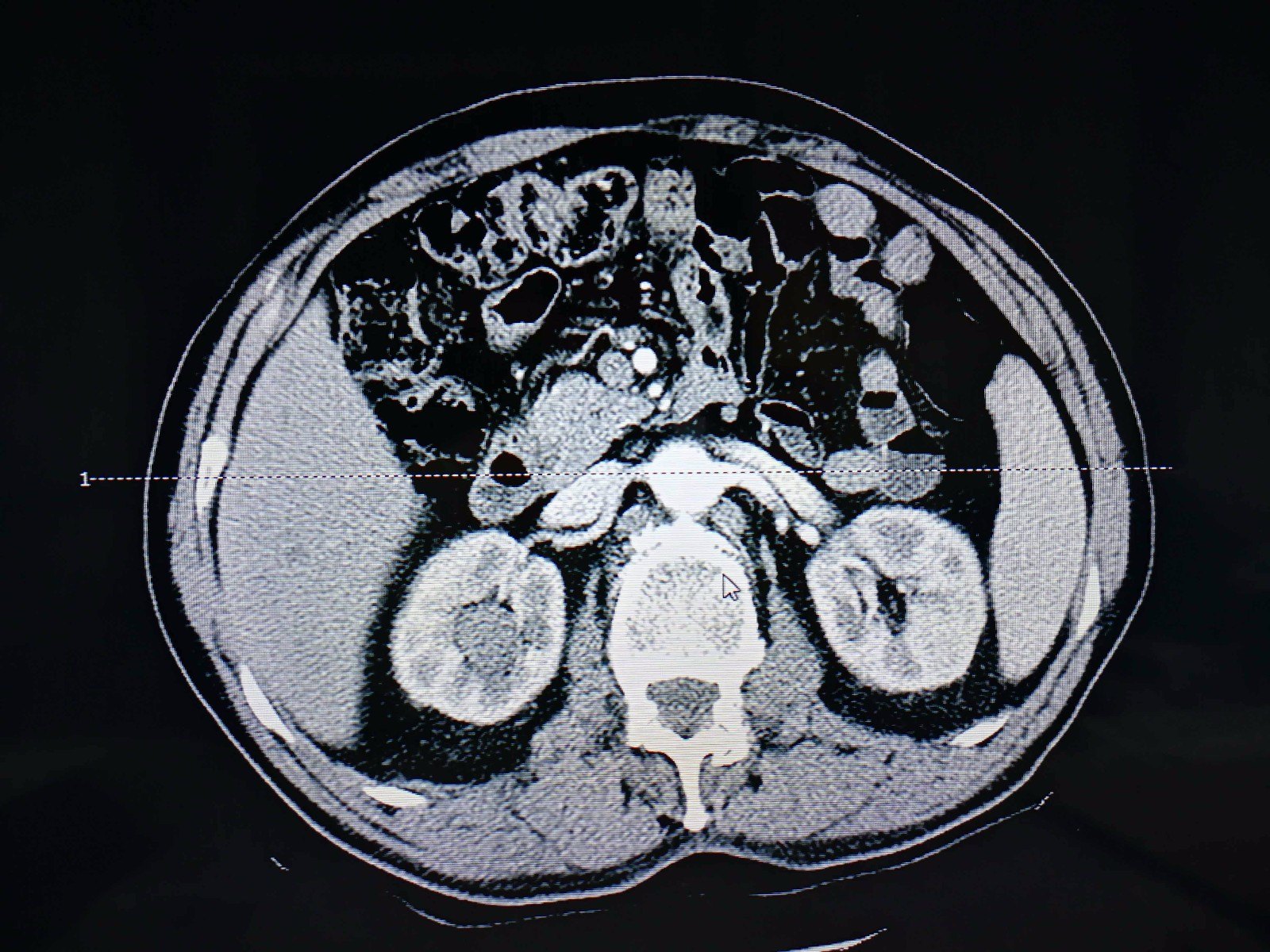 腹腔鏡腎切除部分切除術腫瘤性無功能腎重複腎等