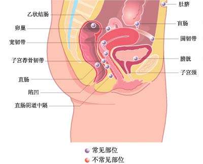 在縫合子宮切口時,勿使縫線穿過子宮內膜層,縫合腹壁切口前應用生理