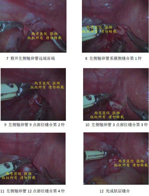 腹腔鏡下輸卵管吻合術