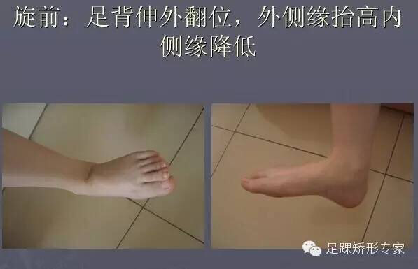 踝關節laugehansen骨折分型