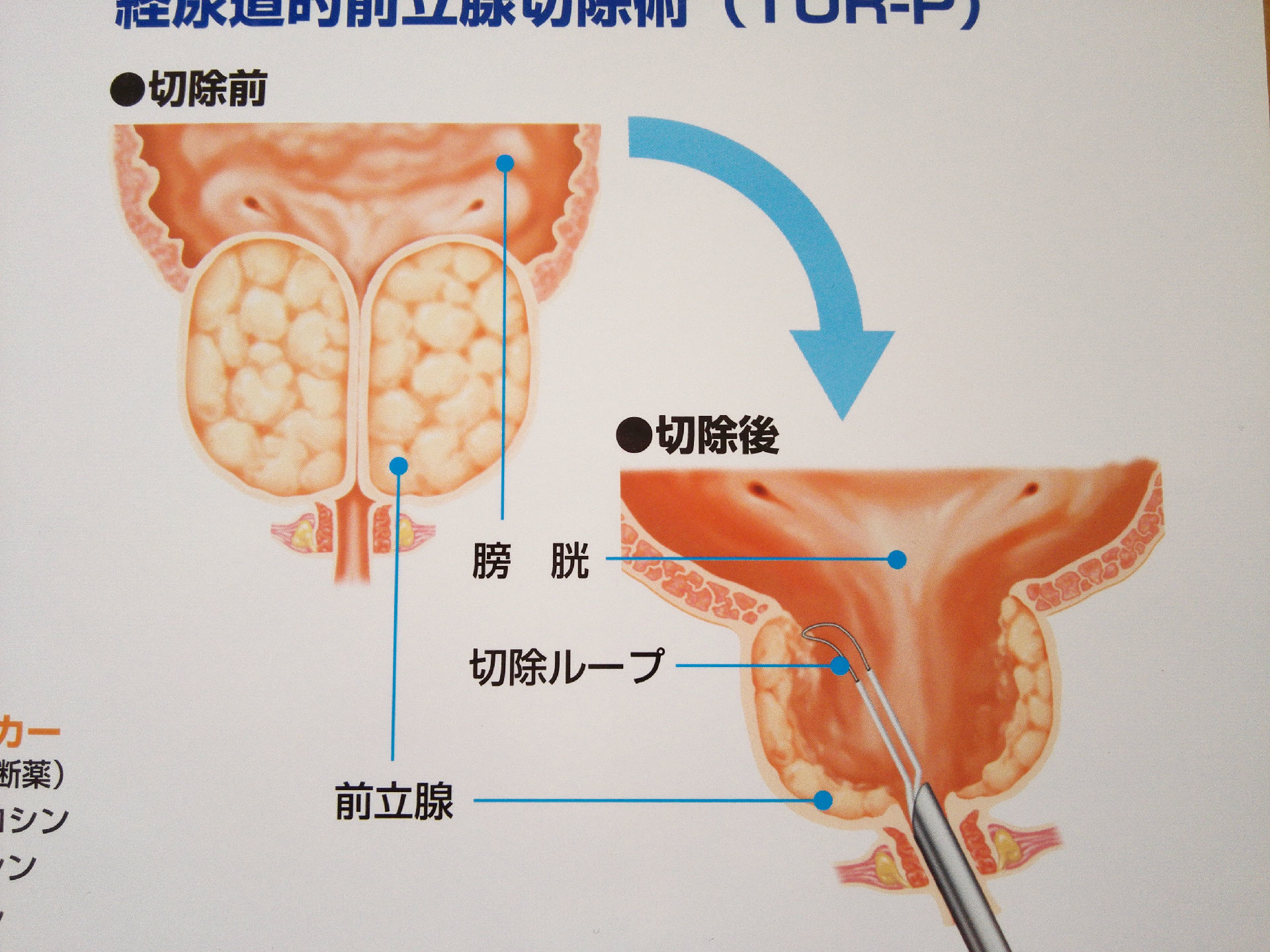 前列腺增生_前列腺增生_手術_治療方式 - 好大夫在線