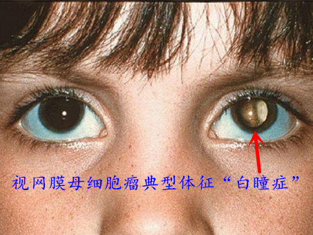 儿童眼病中的死神,定期进行眼病筛查可以早期发现此病,即便发现白瞳症
