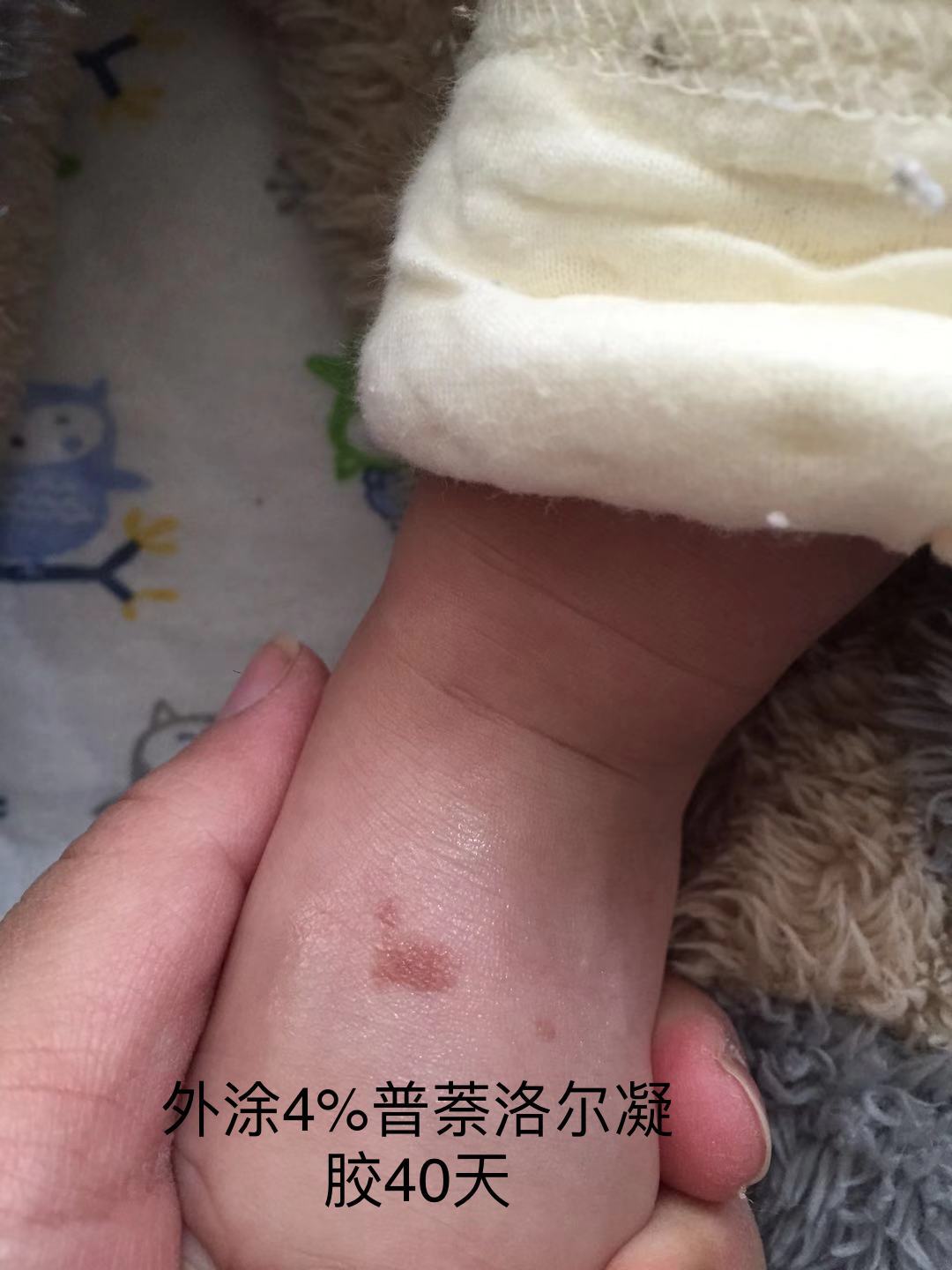 婴幼儿血管瘤及化脓性肉芽肿治疗策略