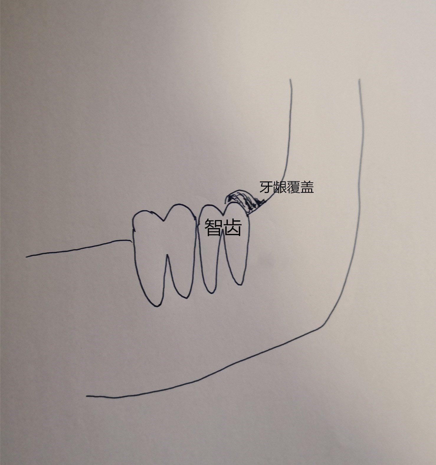 告訴大家一個好消息你的智齒可以不拔啦你拔了嗎