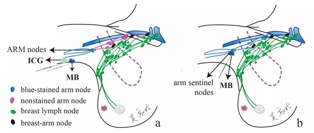吳高松教授團隊在前期研究的基礎上提出了一種 新的乳腺癌腋窩淋巴結