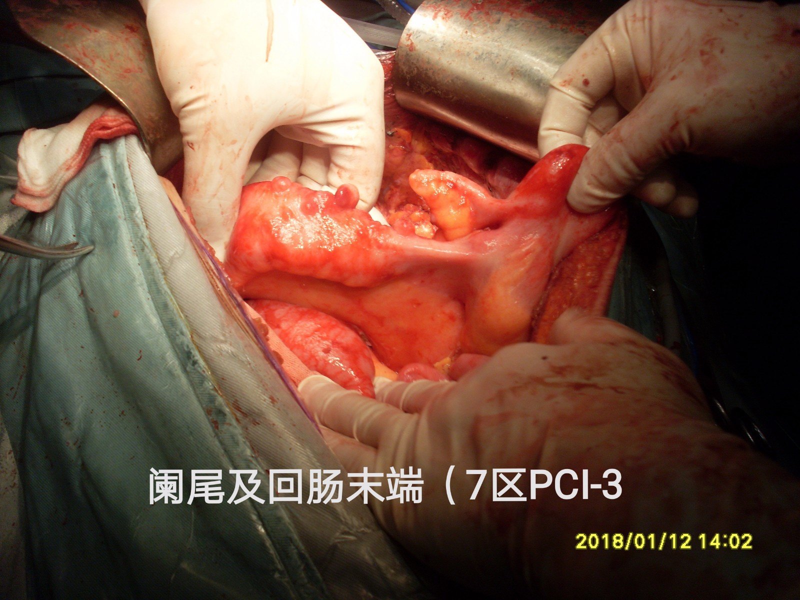 肠梗阻手术 m.haodf.com