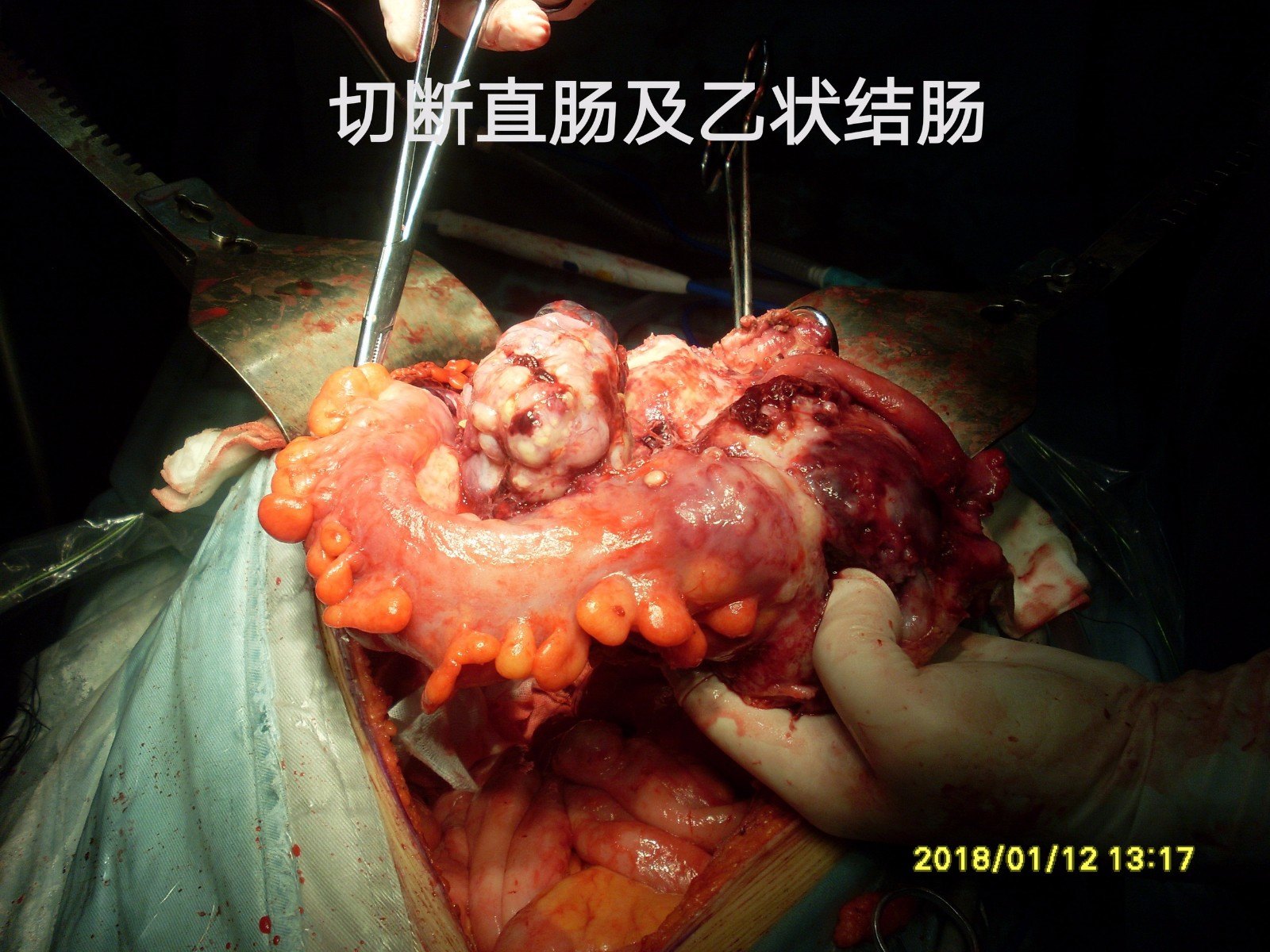 肠梗阻手术 m.haodf.com