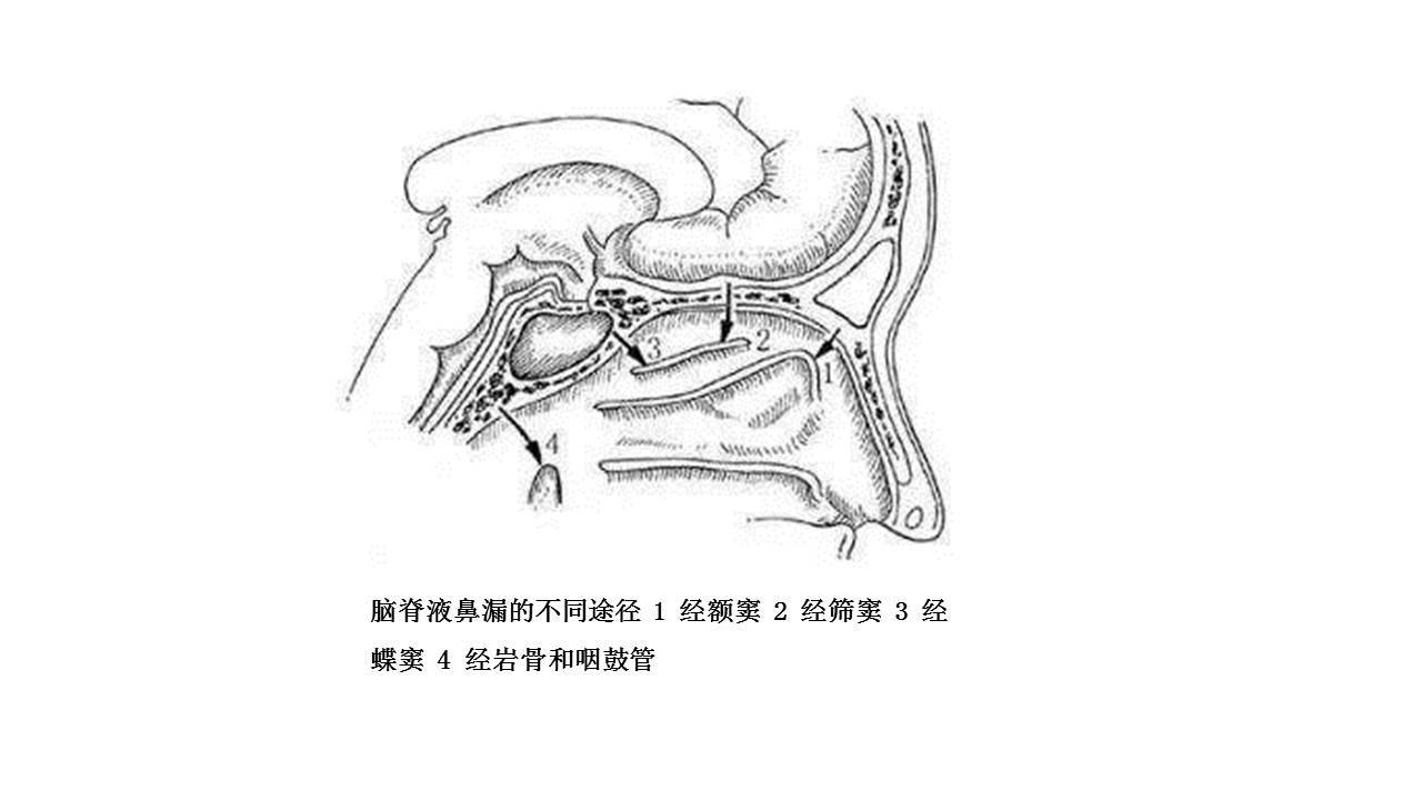 所有的腦脊液鼻漏都必須手術治_腦脊液漏_介紹_治療方式 - 好大夫在線