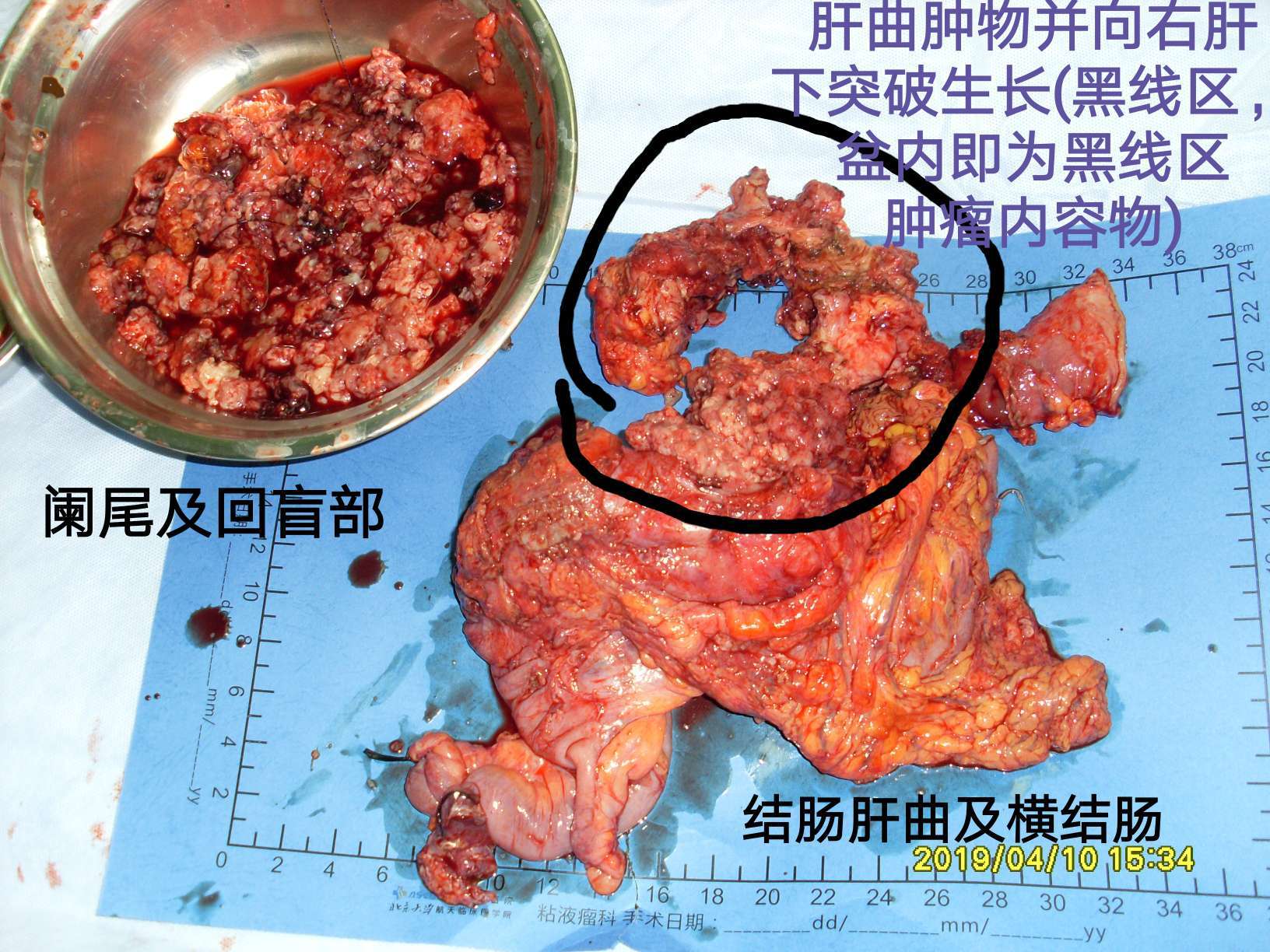 病例40結腸肝曲粘液腺癌突破腸管向外生長