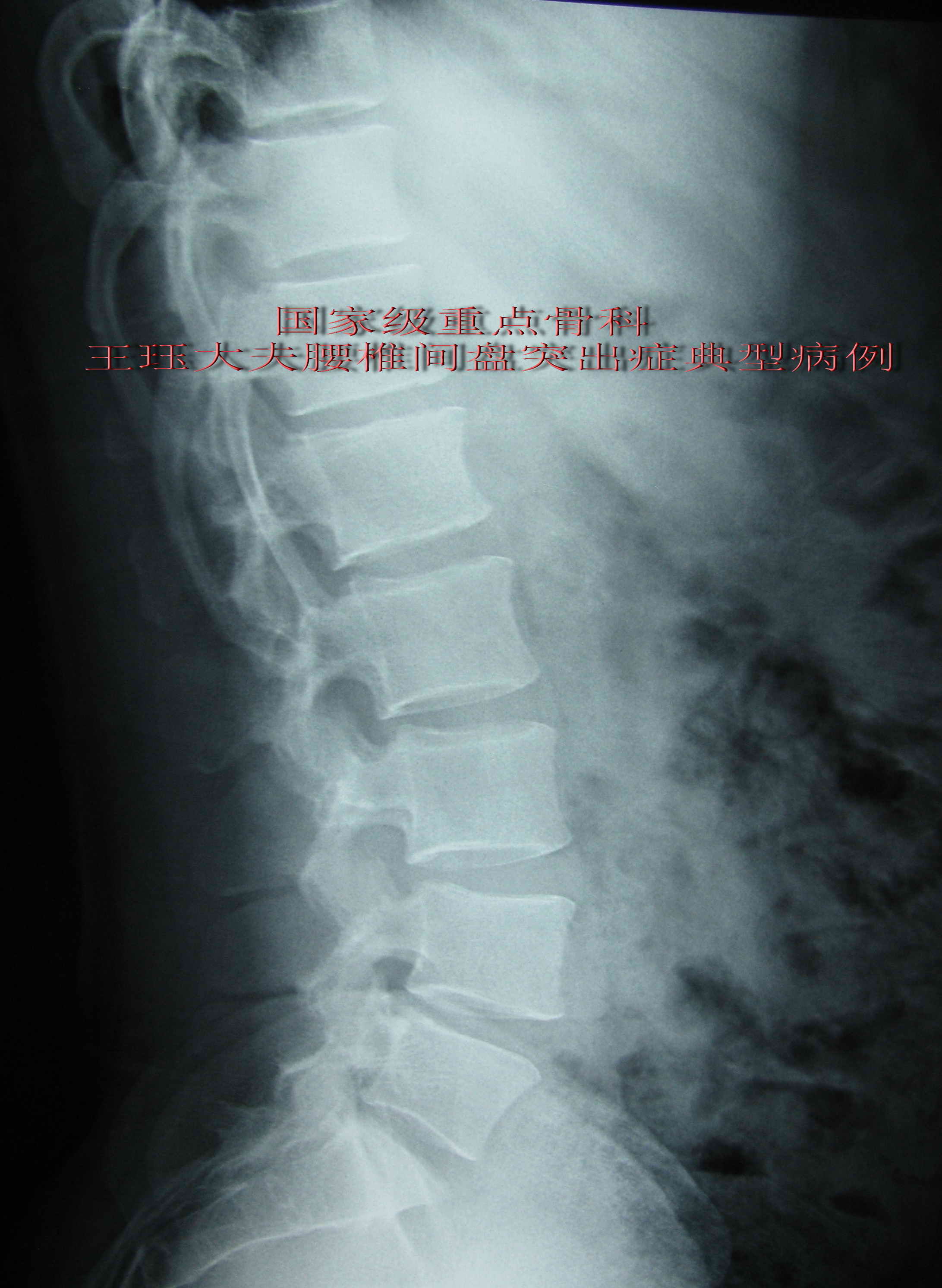 病例17男24歲青年腰椎間盤突出症常見類型椎體後緣離斷症