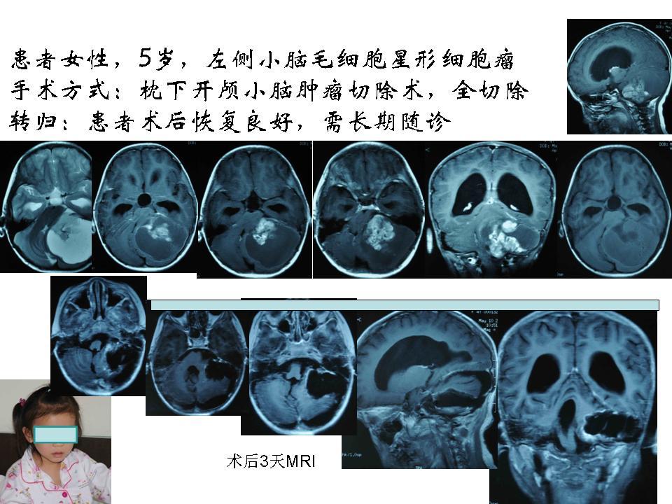 手術切除小兒小腦半球毛細胞性星形細胞瘤