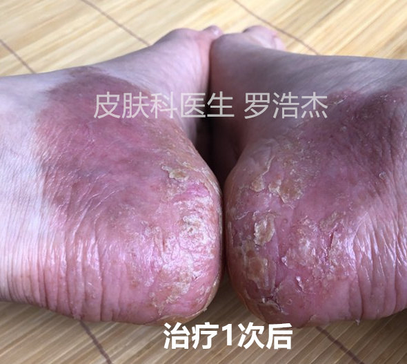 掌蹠膿皰病治療實例