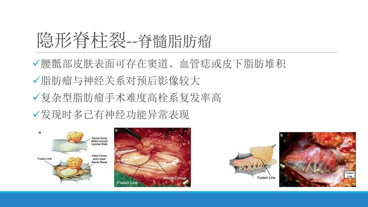 脊柱裂的常见类型及治疗原则