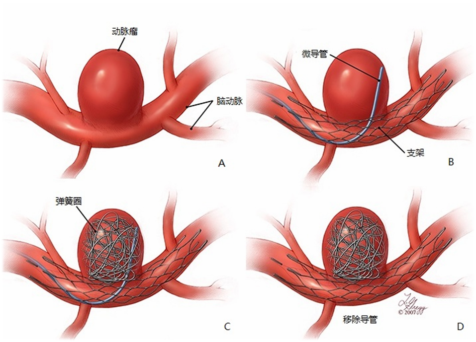 单独应用弹簧圈栓塞比较困难,弹簧圈容易突入载瘤动脉,需要辅助策略