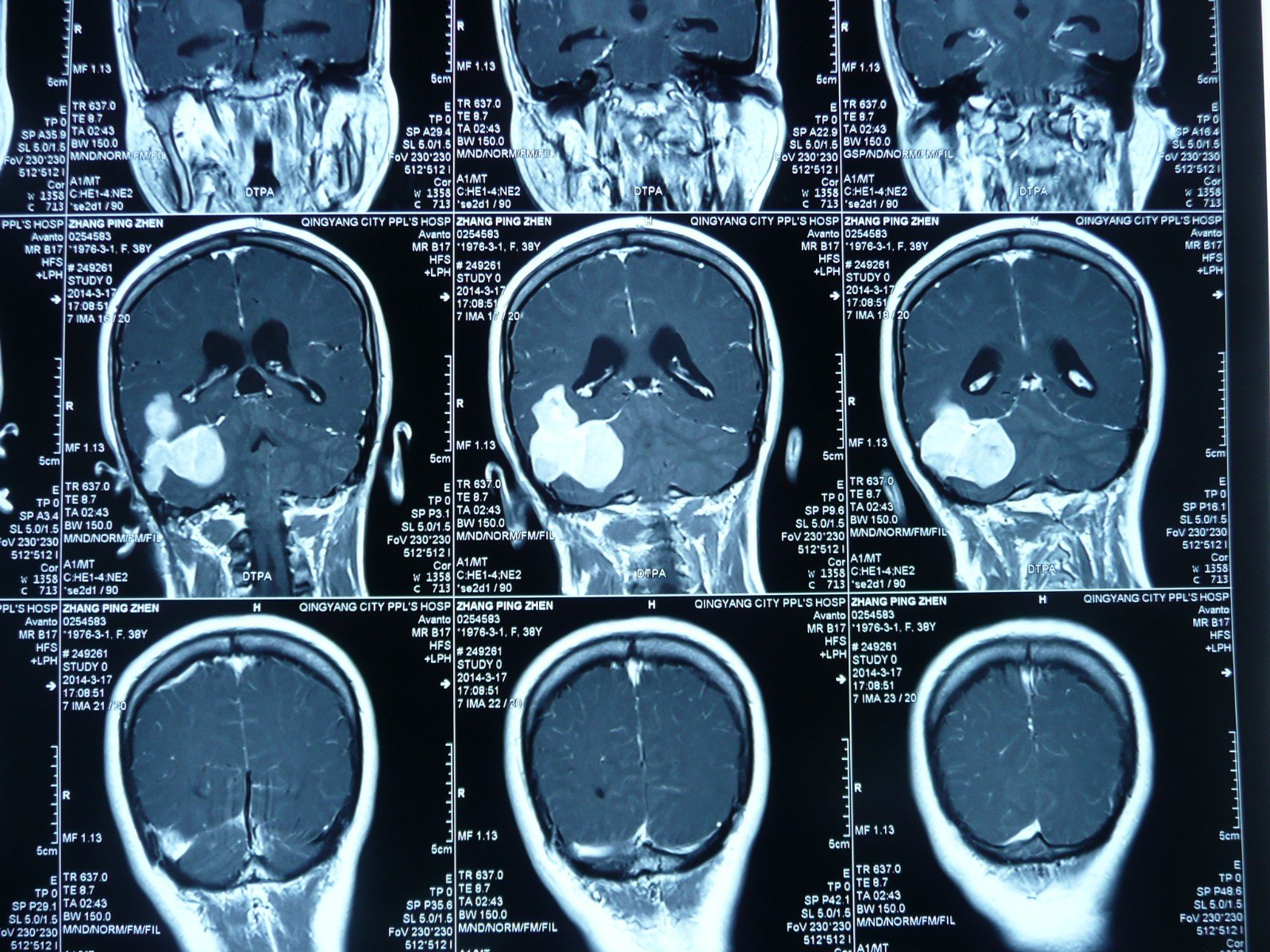 賀曉生教授小腦幕上下騎跨腦膜瘤的外科切除手術案例