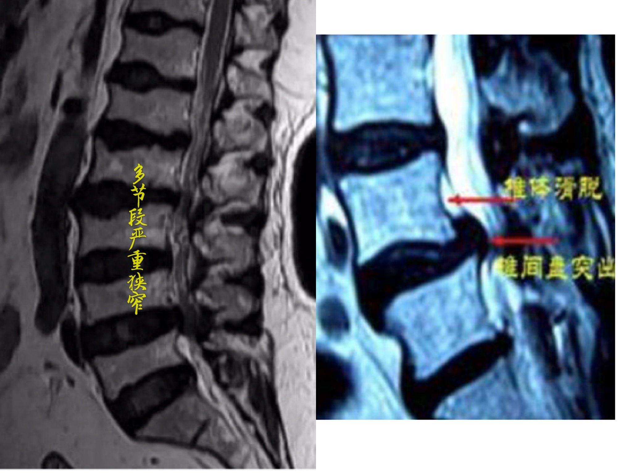 首先,如果您是單純一個節段的間盤突出,推薦您做微創手術.