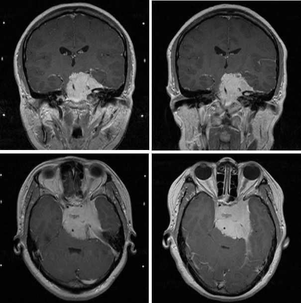 (七)体积巨大的颅底恶性肿瘤所谓颅底肿瘤就是发生在脑子底下,下方的