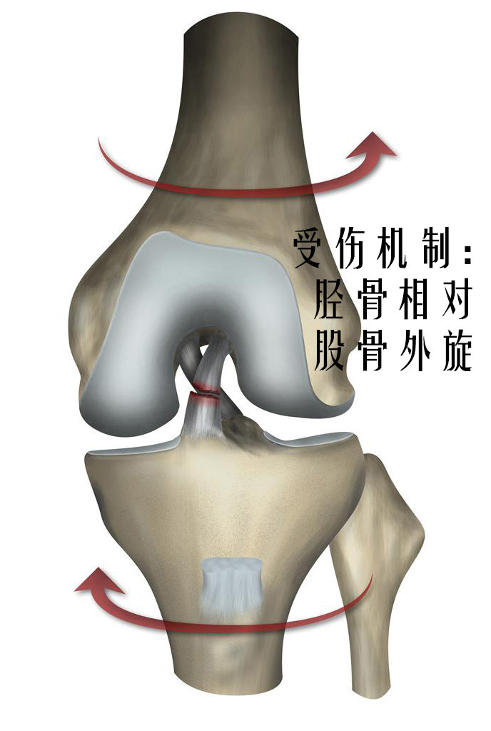 前交叉韌帶撕裂了該怎麼辦