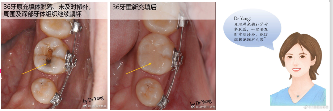 继发龋