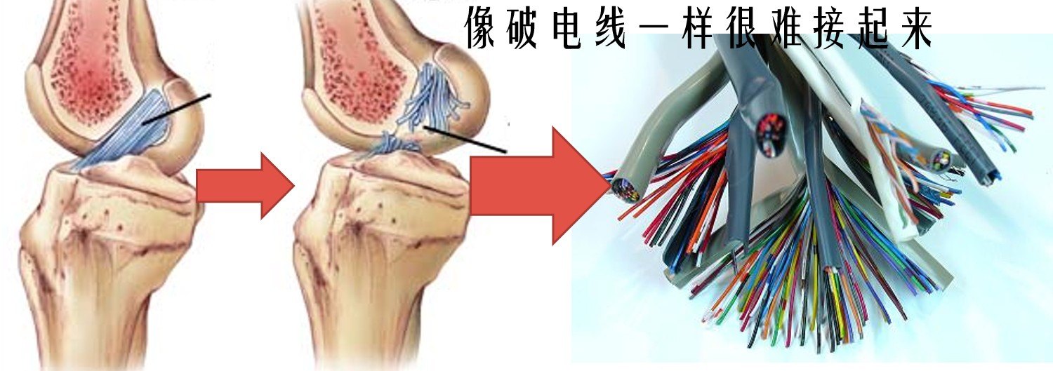 实际上,前交叉韧带的结构有点像电缆,里面有一丝丝的电线,还有橡皮筋