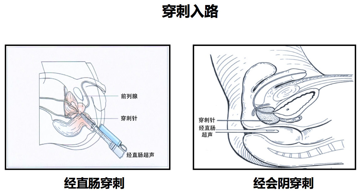 什么是前列腺穿刺活检