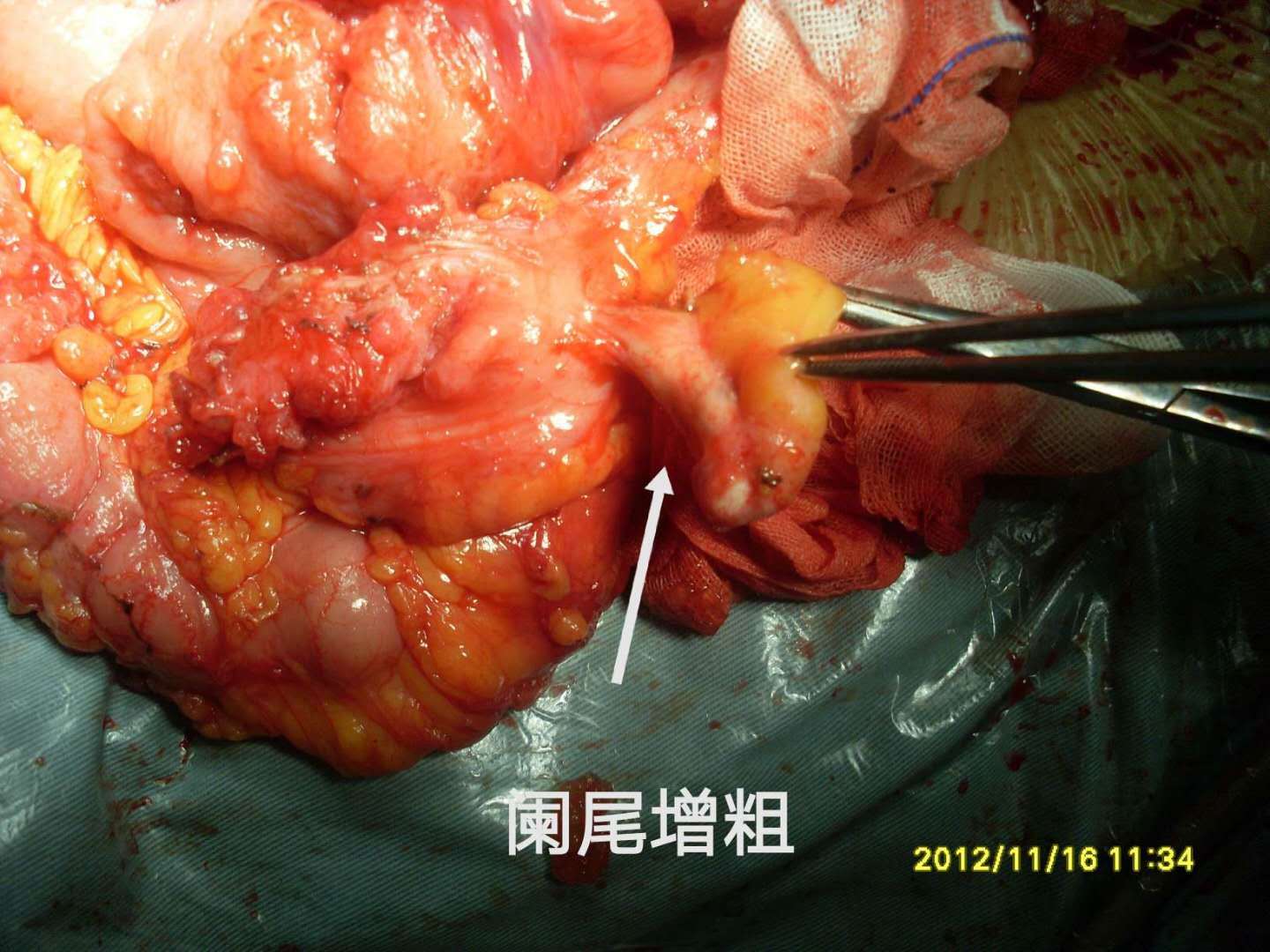 病例60阑尾粘液囊腺癌高级别pmp7年3次手术