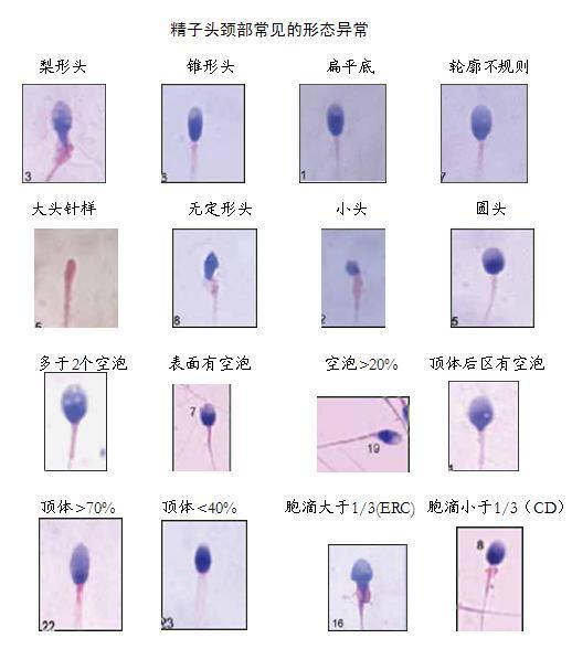 在大家的想法中,正常形态的精子应该是绝大多数的,然而恰恰相反,超过