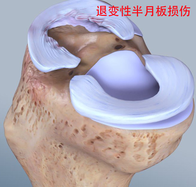 日復一復的反覆屈膝伸膝導致退變的半月板發生損傷