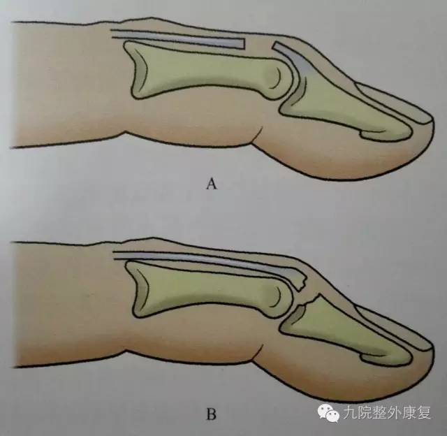 錘狀指的治療與康復