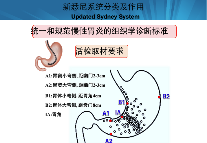 慢性胃炎OLGA、OLGIM分期以及随访流程 - 好大夫在线